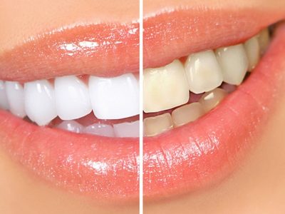Blanqueamiento dental casero: Tratamientos efectivos