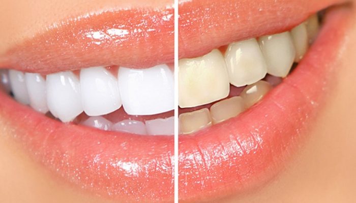 Blanqueamiento dental casero: Tratamientos efectivos