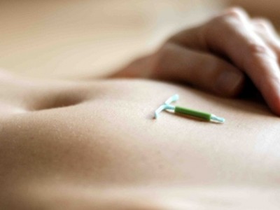 DIU, que tiene efectos secundarios en la menstruación