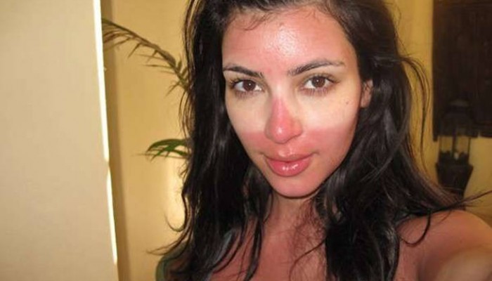 Famosos quemados bajo el sol: Las quemaduras de las celebs
