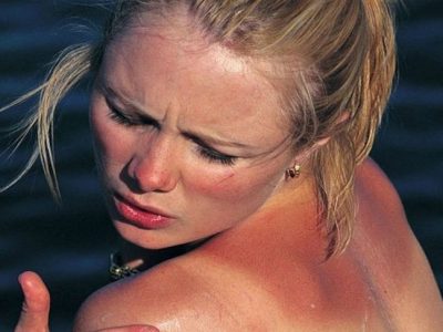 Melanoma: Síntomas y características del cáncer de piel