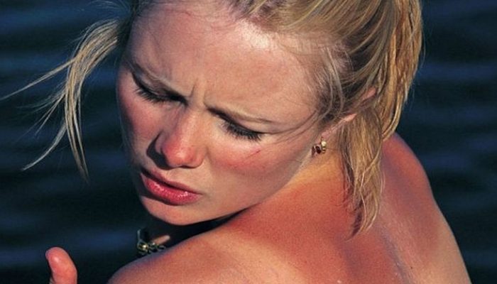Melanoma: Síntomas y características del cáncer de piel