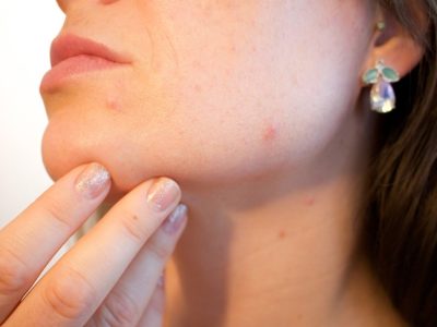 Maskné: todo lo que debes saber sobre el acné provocado por el uso de mascarillas
