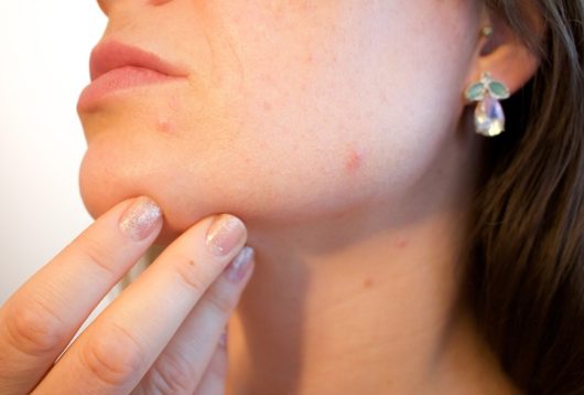 Maskné: todo lo que debes saber sobre el acné provocado por el uso de mascarillas