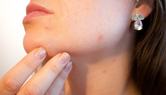 Maskné: todo lo que debes saber sobre el acné provocado por el uso de mascarillas